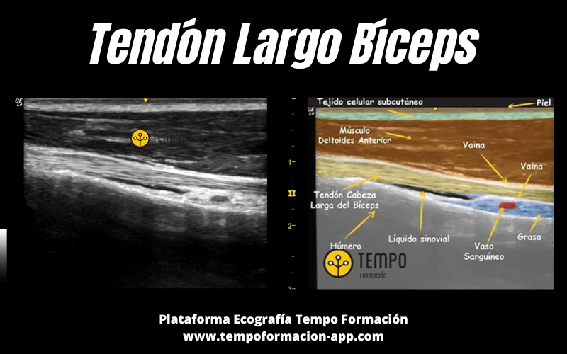 4. Tendon Largo Biceps Ecografia Tempo Formacion.png